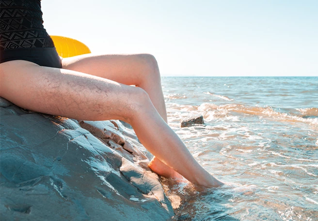 ¿Qué son las arañas vasculares?