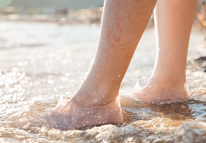 Varices, sol y playa