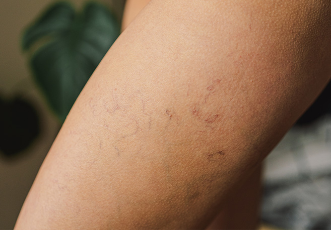 Cómo evitar que las varices avancen